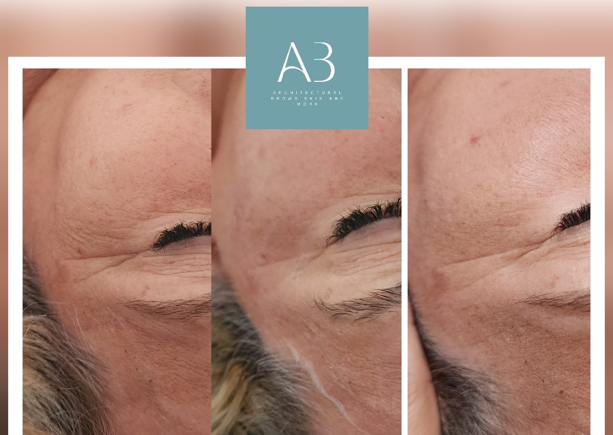 Radiofrecuencia facial