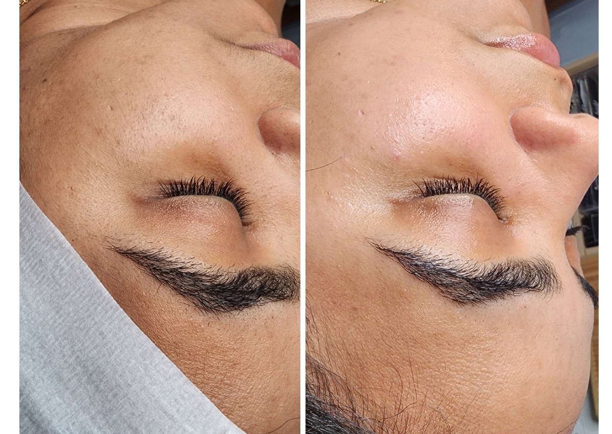 Dermaplaning facial