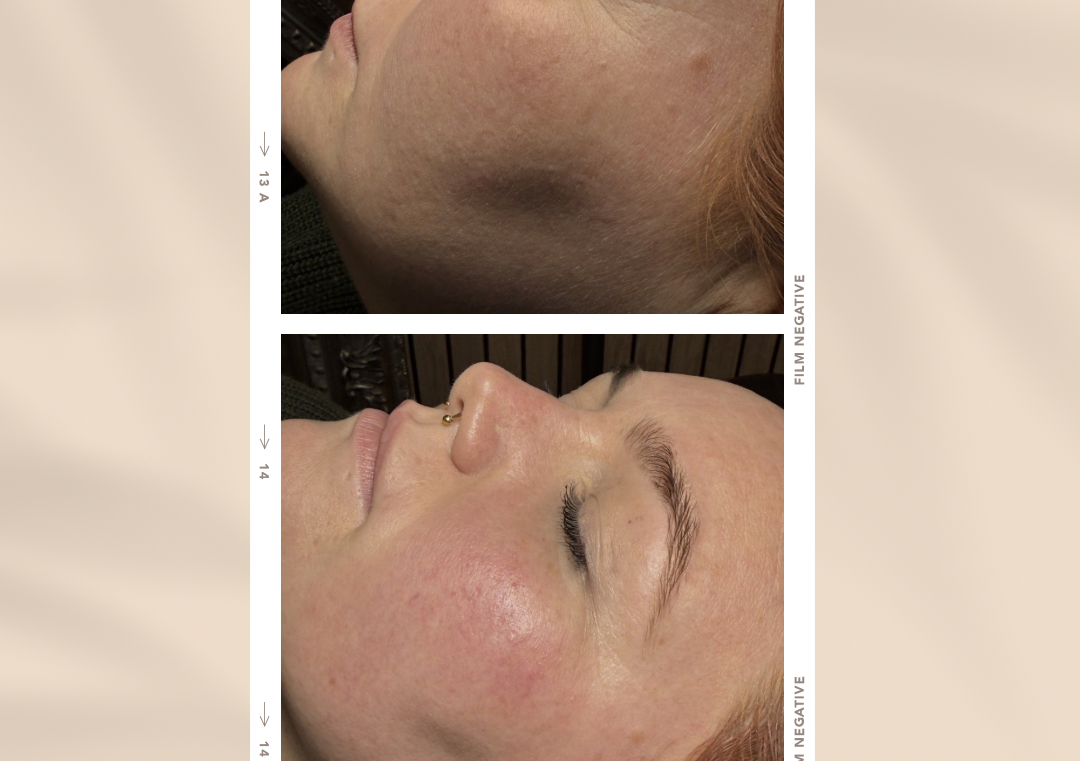 Dermaplaning 