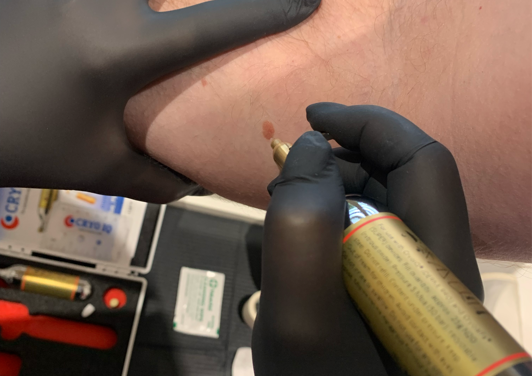 Cryopen Blemish Removal- 4-5 Blemishes