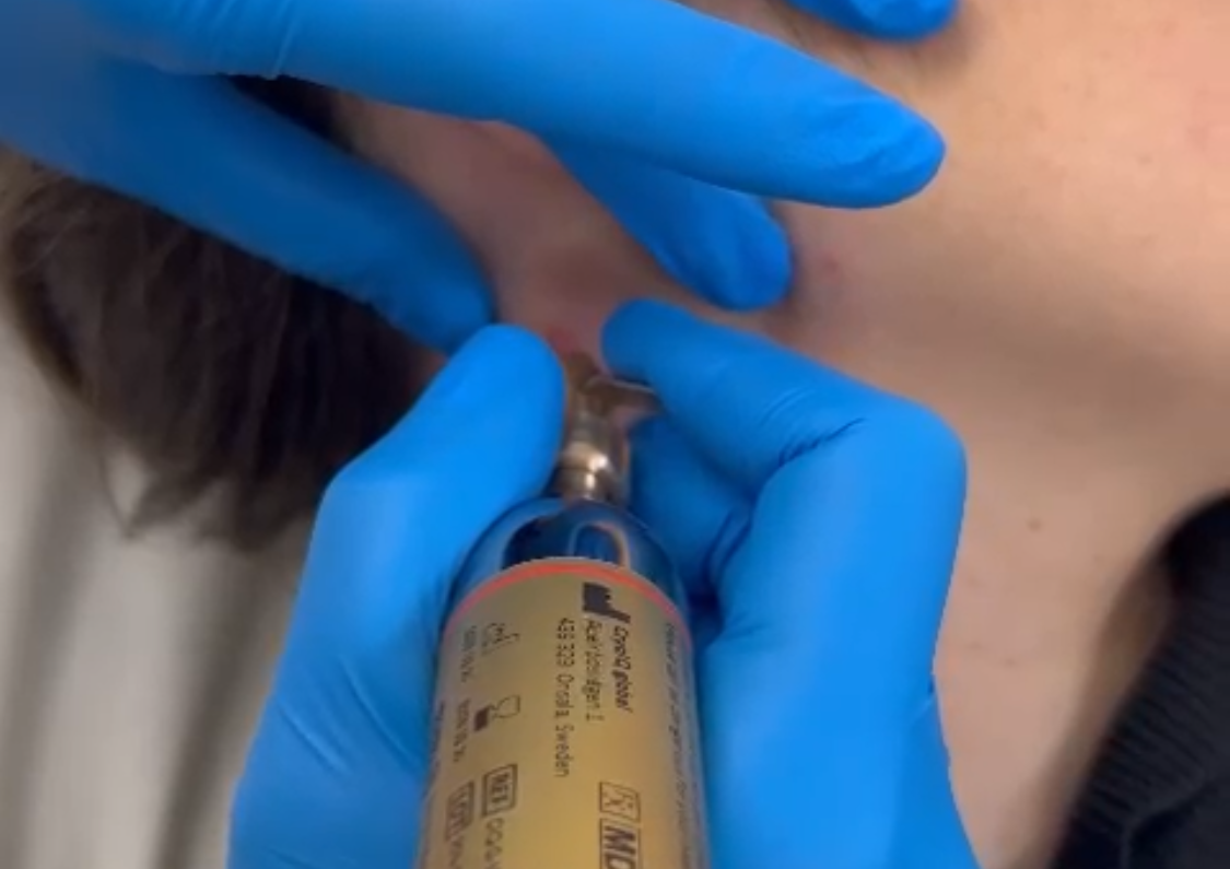 Cryopen Blemish Removal- 2-3 Blemishes