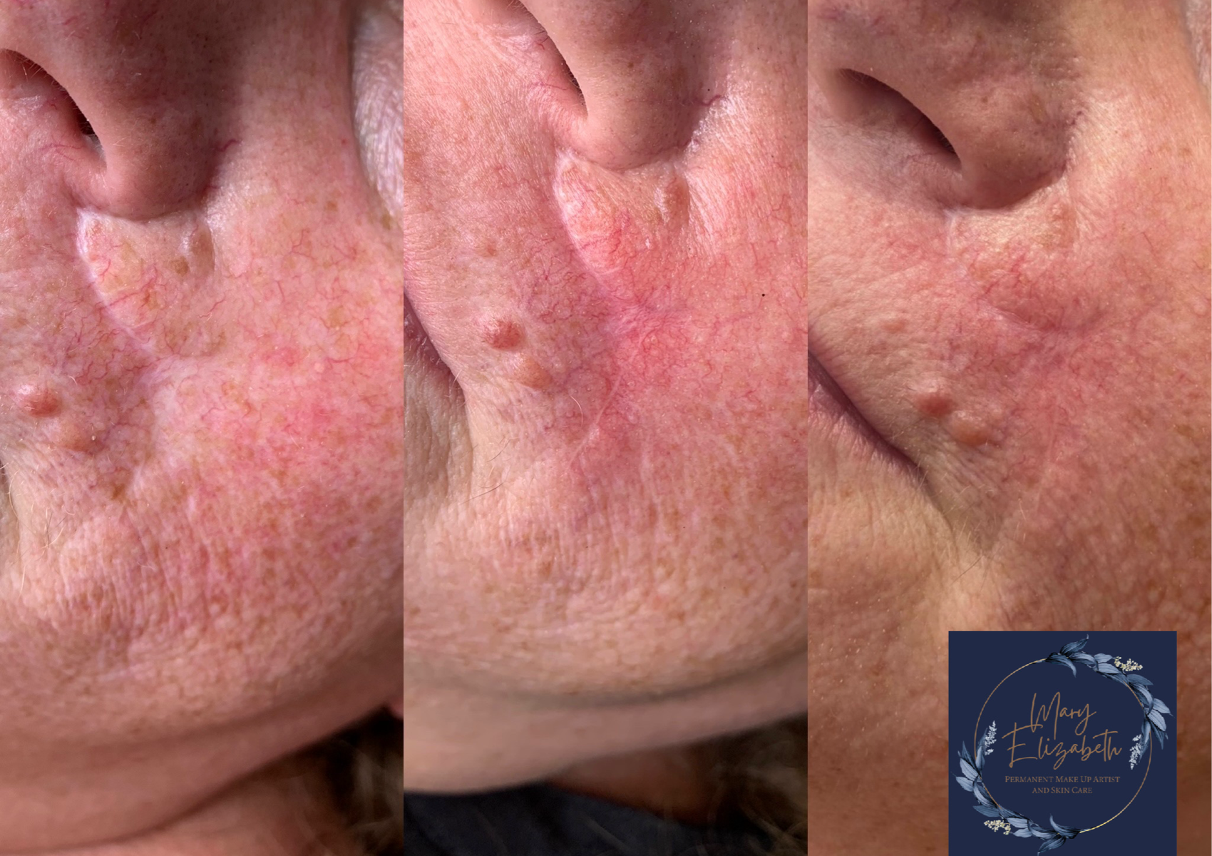 Microneedling of Scar Tissue