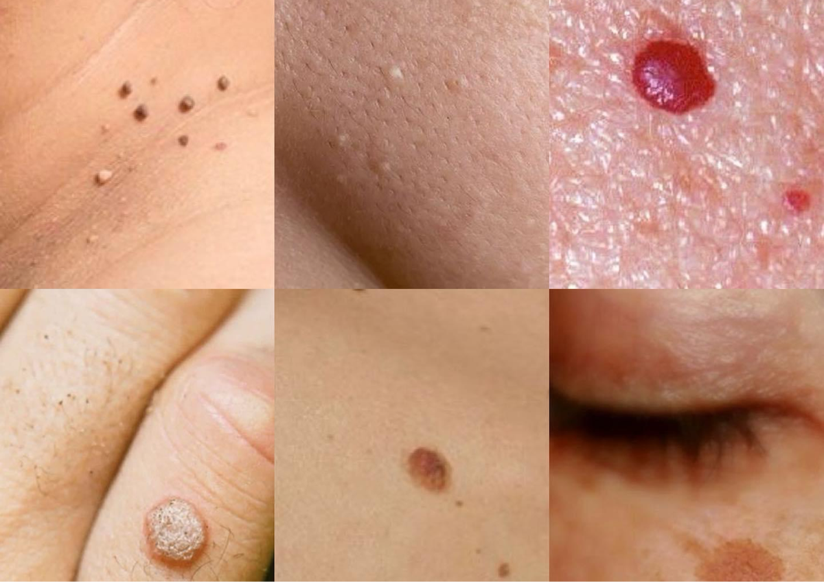 Cryopen Blemish Removal- 1 Blemish