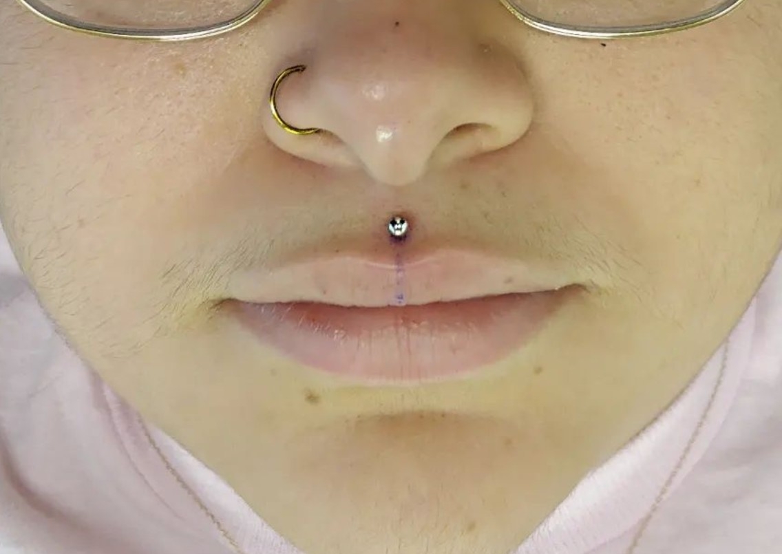 Philtrum/Medusa