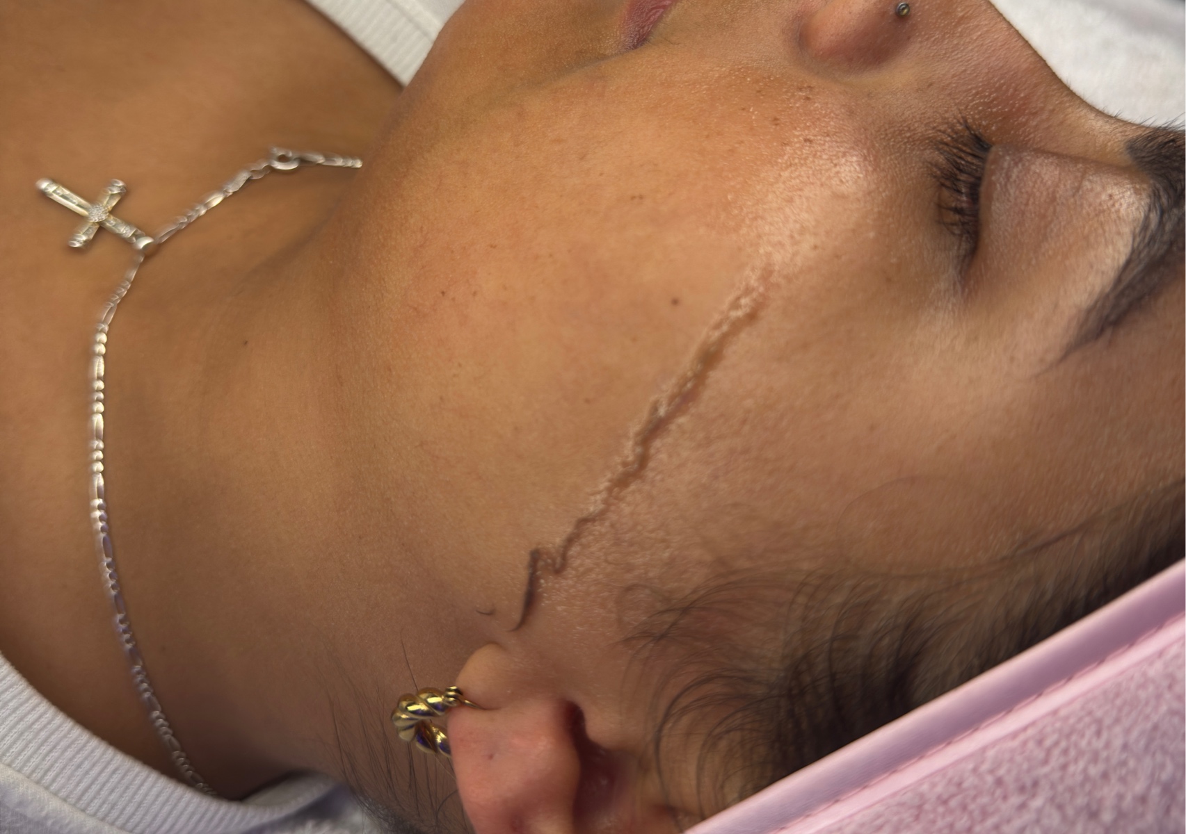 Dermaplaning 