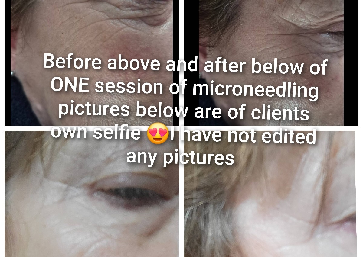 Microneedling 