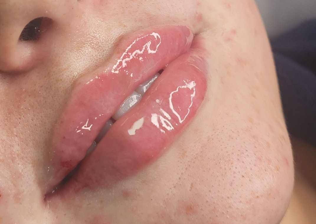 1 Ml Lip Filler For 2 People 