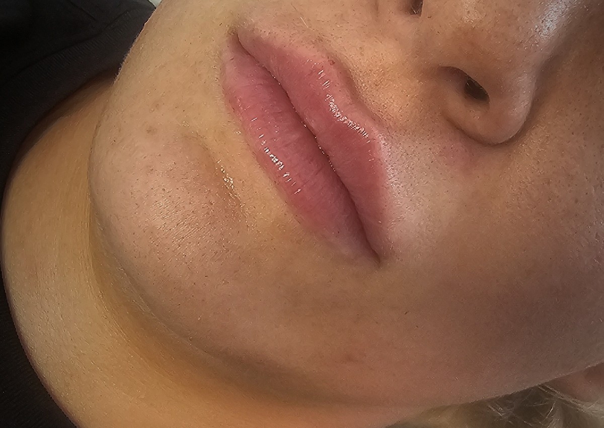 Lip Filler Half ML