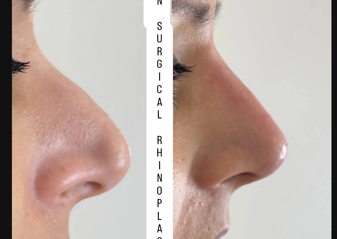Nose Filler 