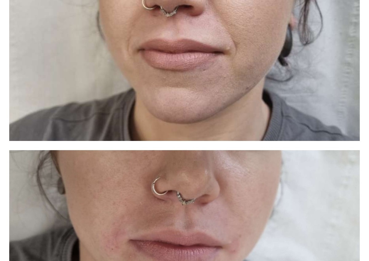 Nasolabial Folds Filler