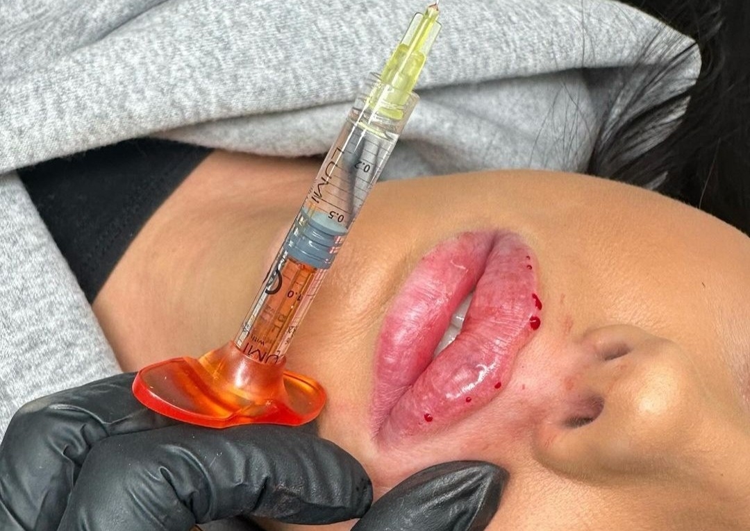 Lip Filler 1Ml