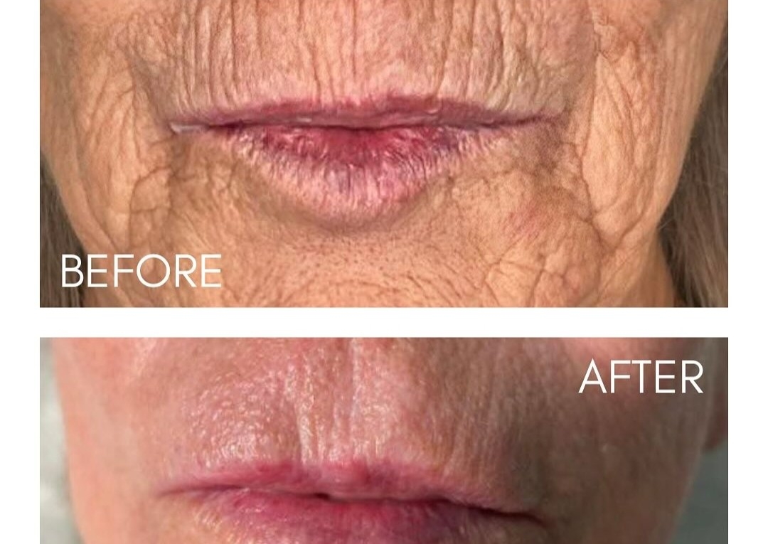 Smoker Lines (above lip) 