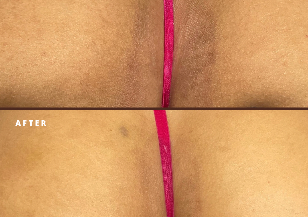 Package Aclarante Zonas Intimas 