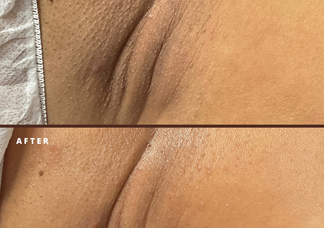 Aclaracion de zonas intimas (1 sola seccion)