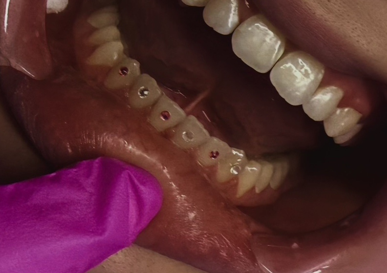 Nova Tracks - Top or Bottom