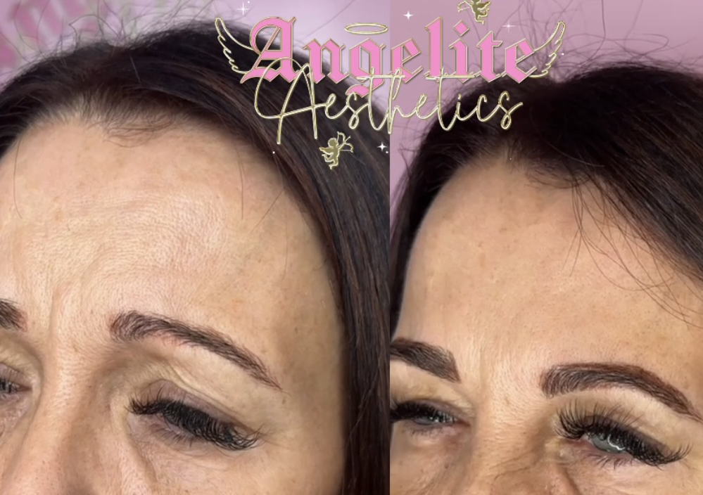 3 areas anti wrinkle treatment