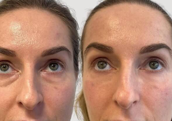 Tear trough filler 
