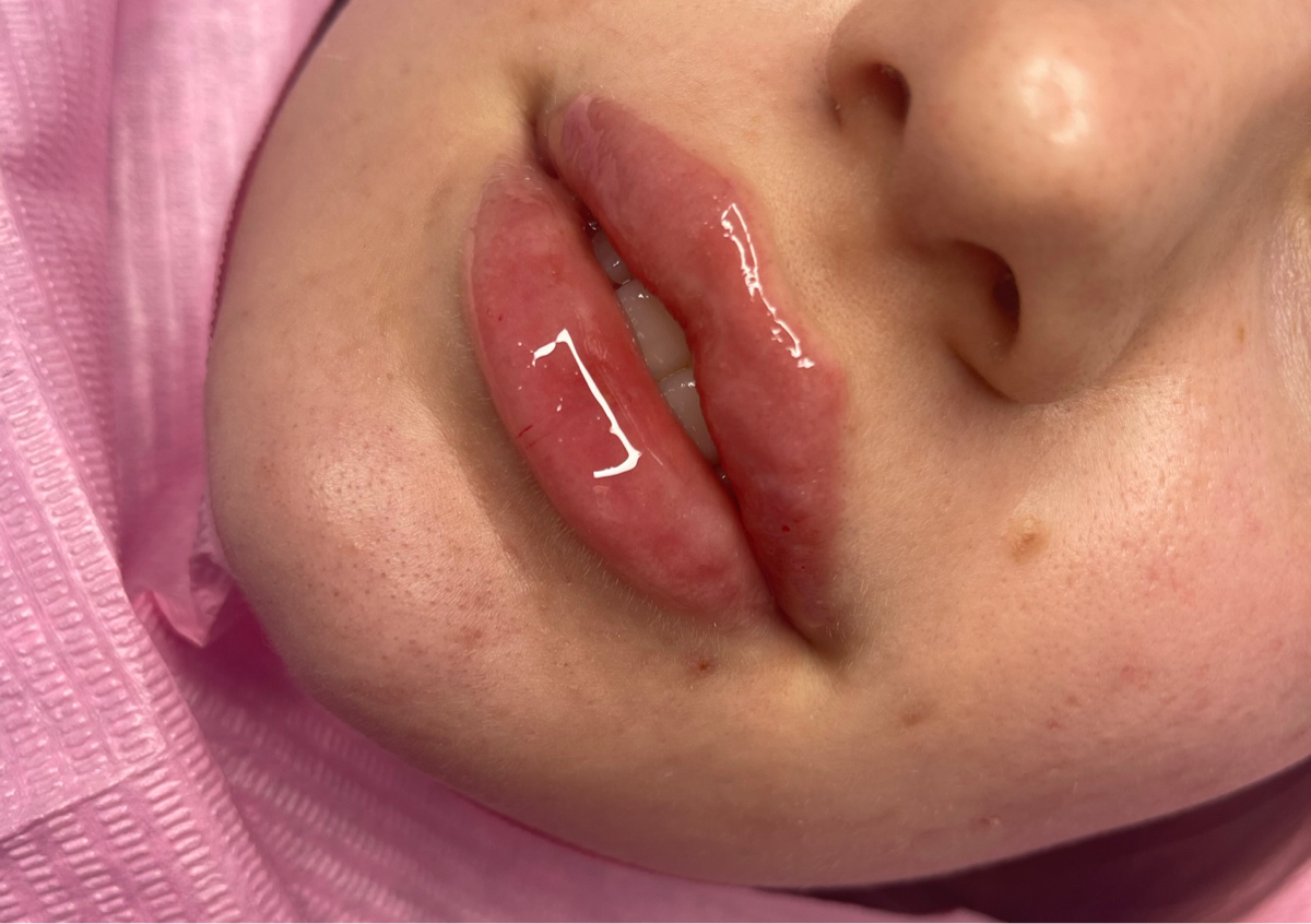 0.5ml / 0.7ml / 1ml lip filler 