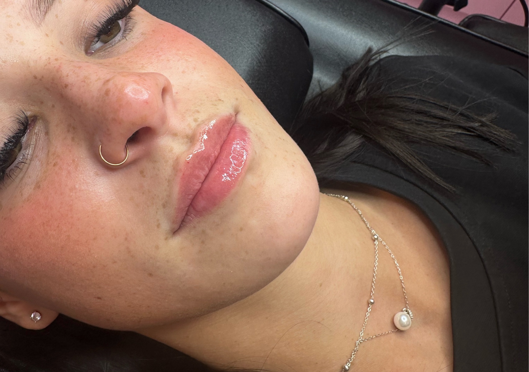 0.5ml Lip filler 