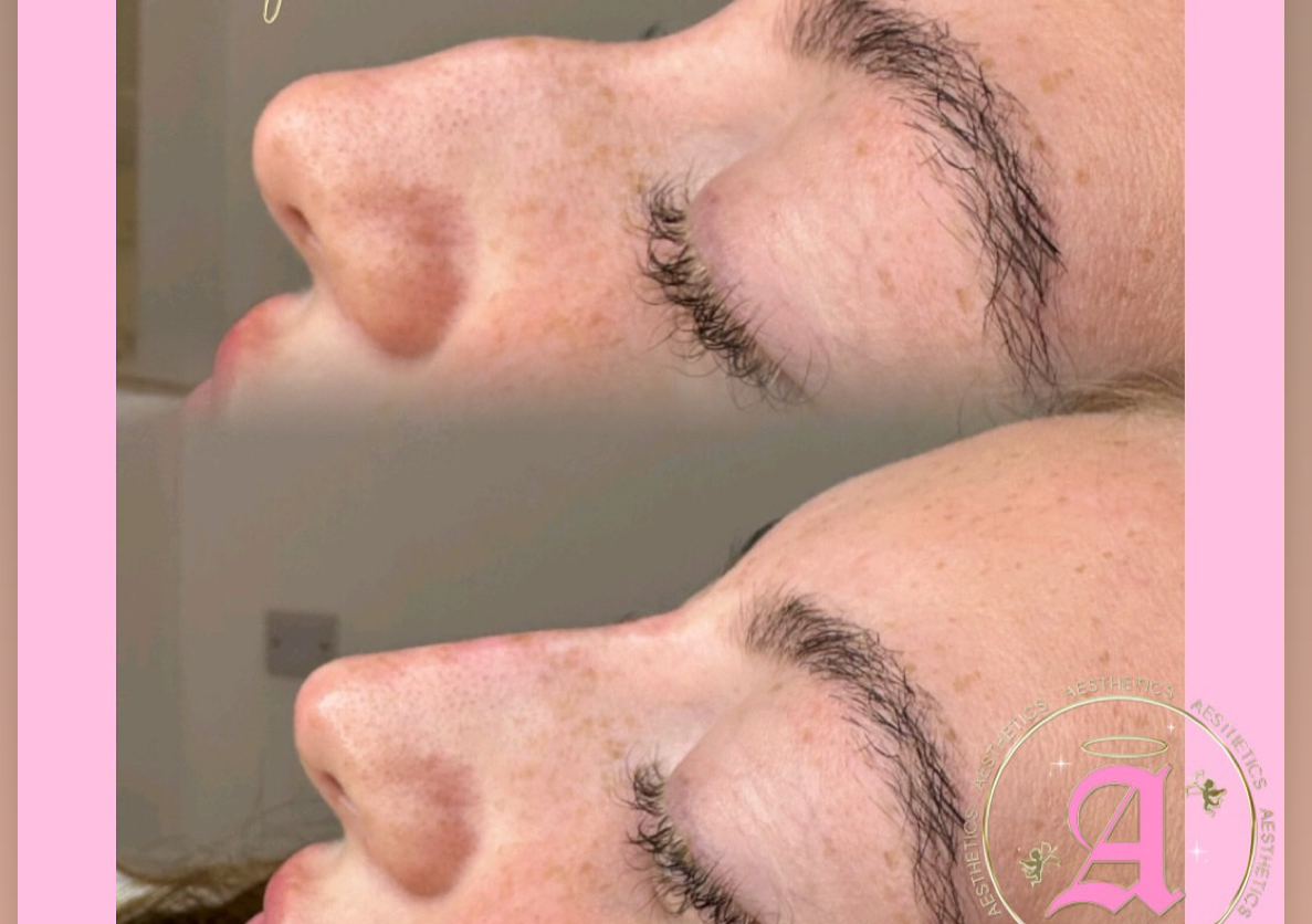 Non surgical rhinoplasty 