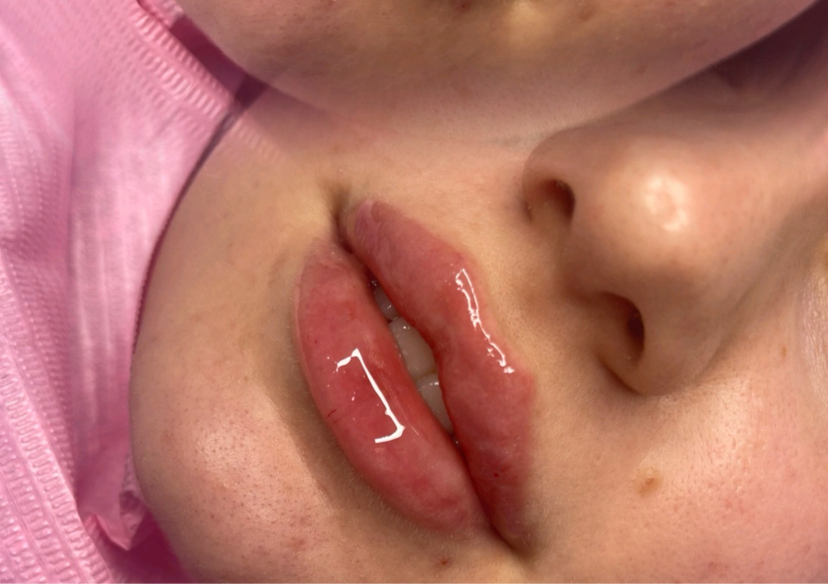 Lip Dissolve and refill 