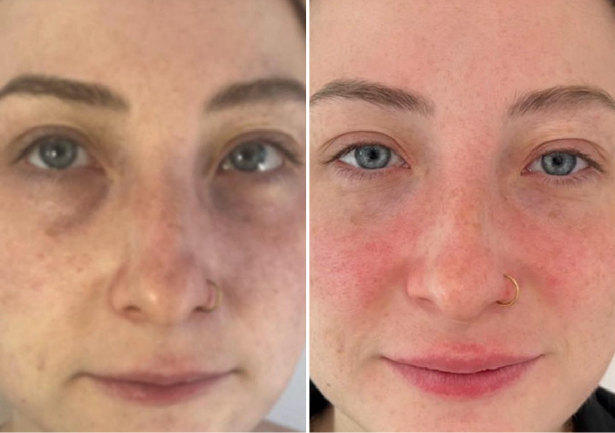 Eye and skin booster combo 