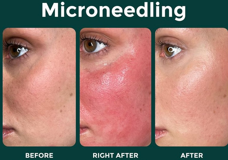 SKIN DR. PEN MICRONEEDLING (SESSION)