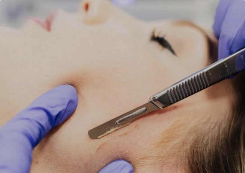DERMAPLANING 