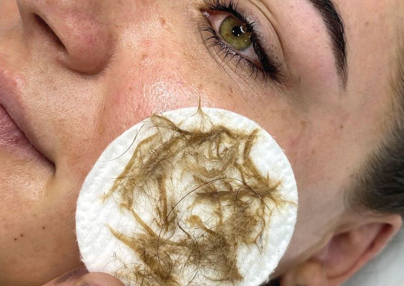 ADD-ONS DERMAPLANING