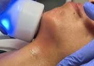 CRYO DOUBLE CHIN