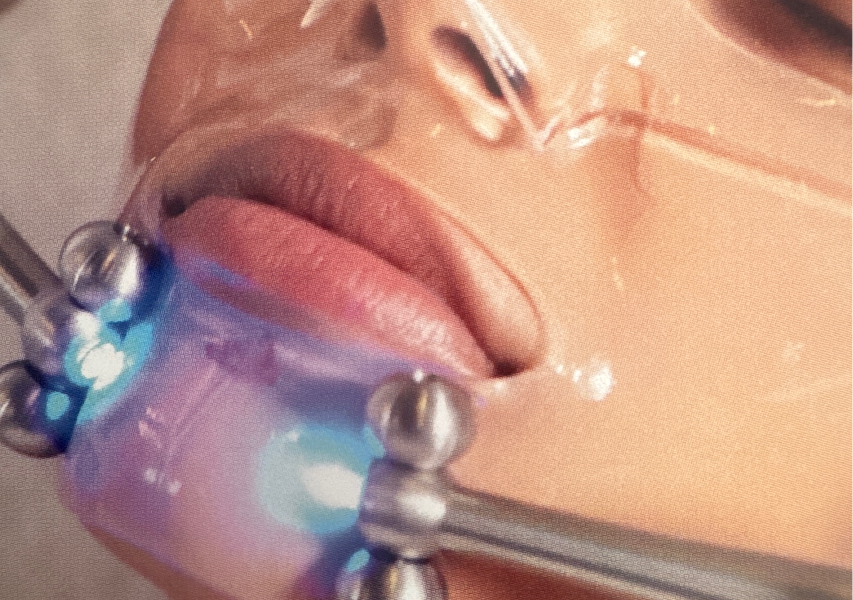 CACI Hydratone Facial