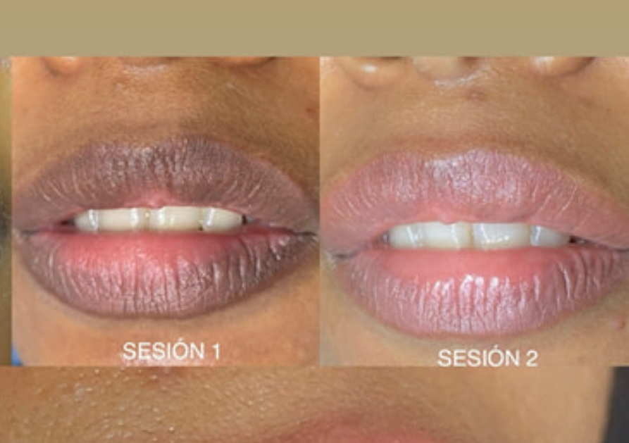 Neutralización de Labios