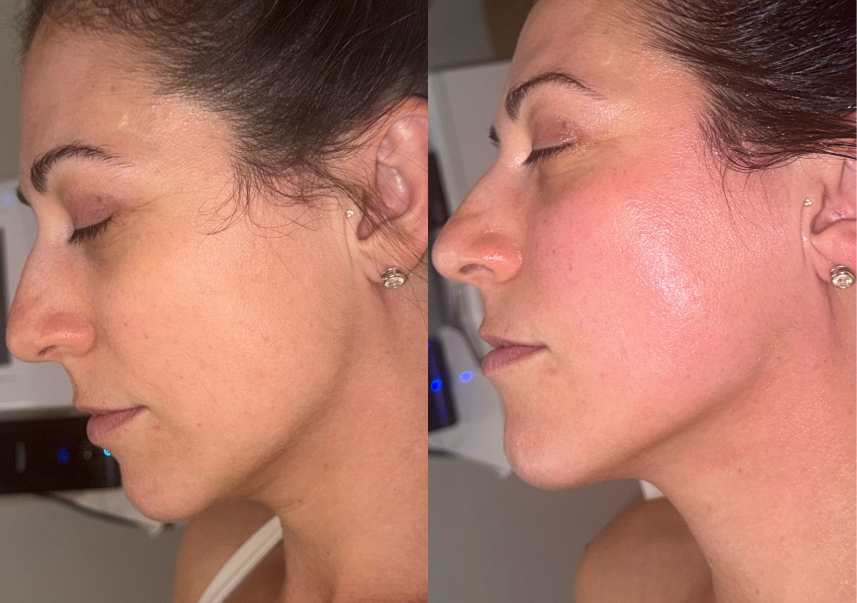 Devine Face Lymphomodelling