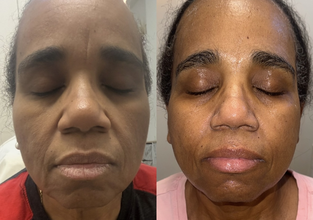 Jet Plasma D66 treatment 