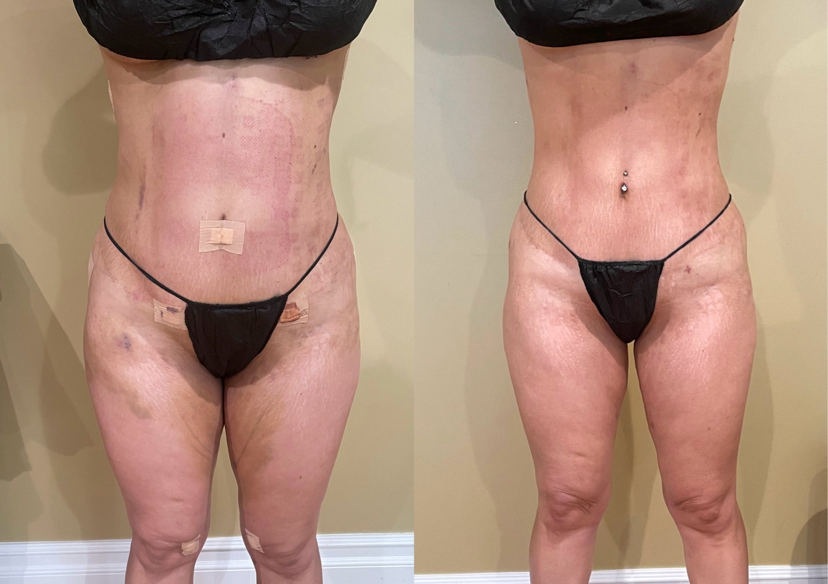 Post-Op Lymphatic Drainage Massage