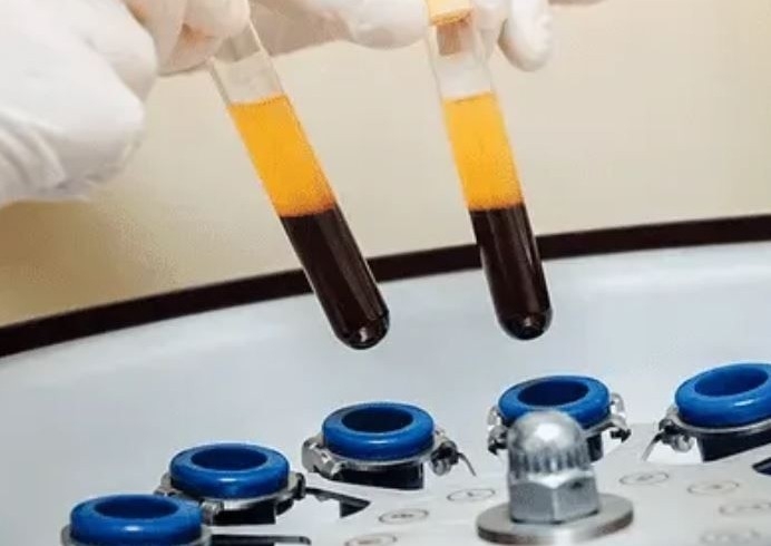 PRP for face and neck. Including microneedling 