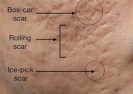 3 sessions of microneedling for face & neck