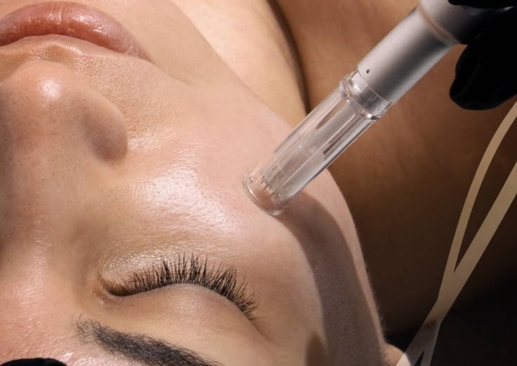 One session of microneedling for face & neck (free IMAGE mask)