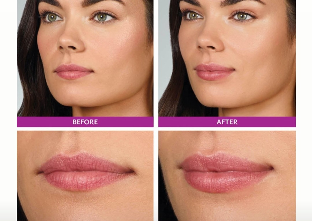Premium Juvéderm Volbella lips