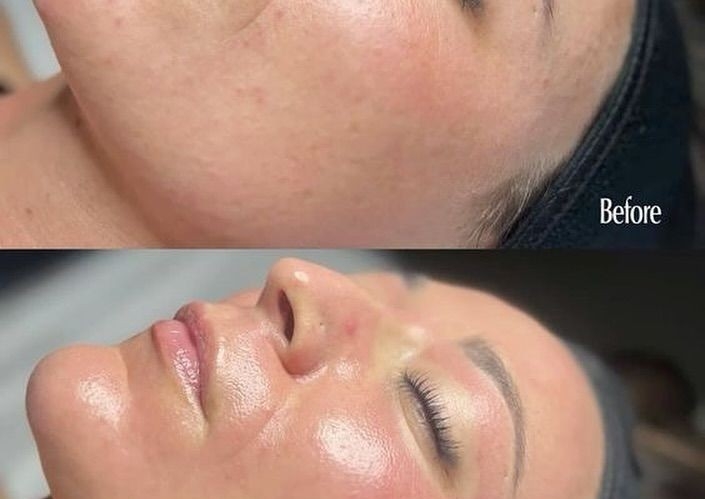 6 sessions of microneedling for face & neck