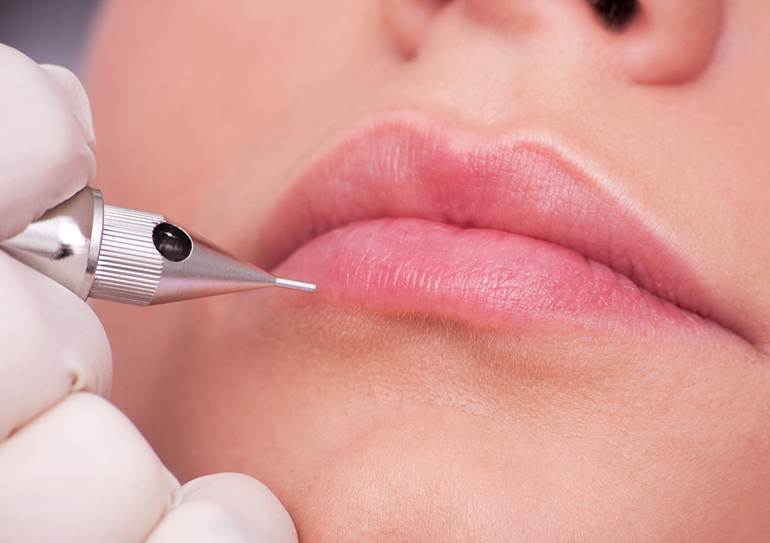 Microneedling Labbra