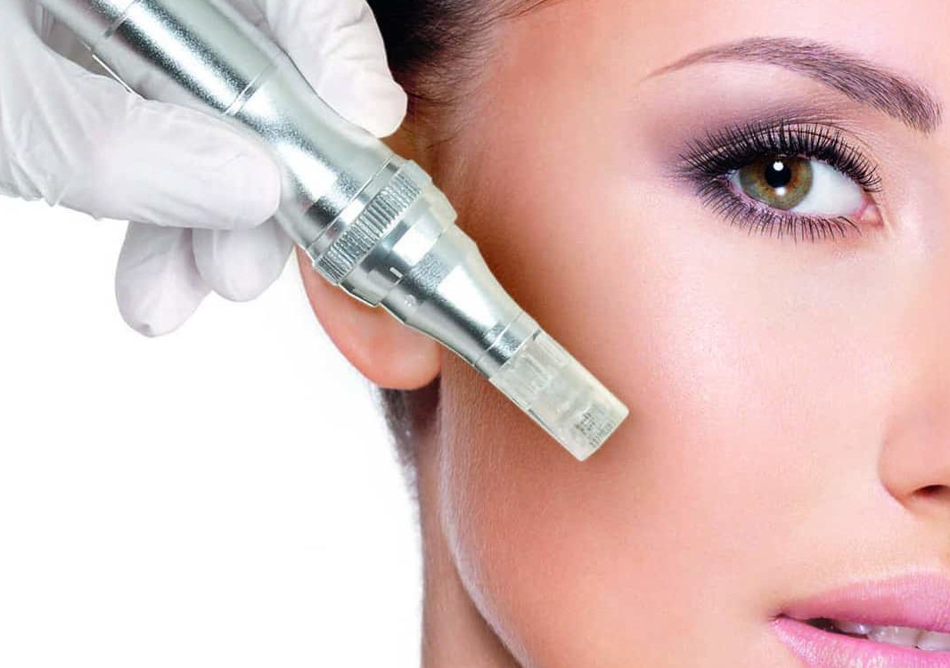 Trattamento Microneedling 