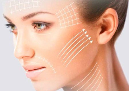 Trattamento Fili di Collagene