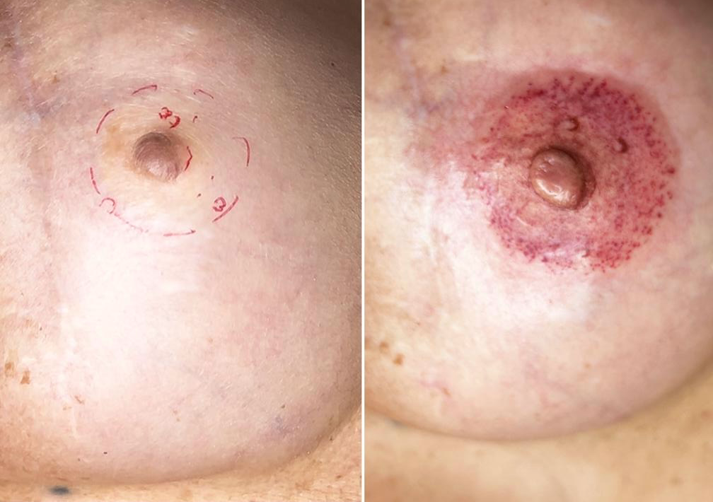 Ricostruzione Areola Mammaria