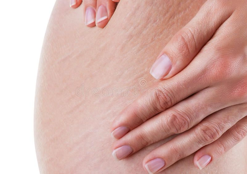 Microneedling su Smagliature