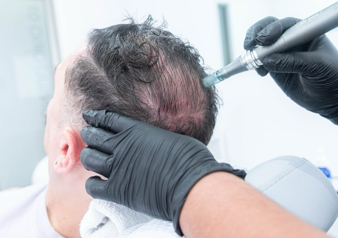 Microneedling su calvizie (capelli e barba)