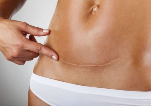 Microneedling su cicatrici