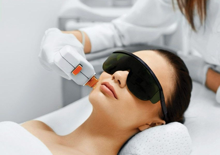 Epilazione laser Viso