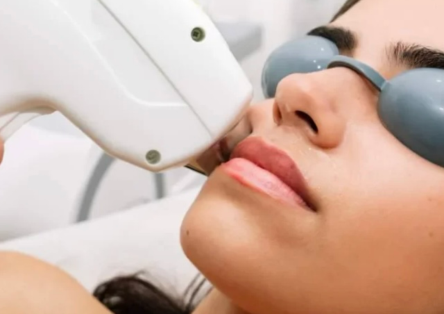 Upper lip and chin - IPL