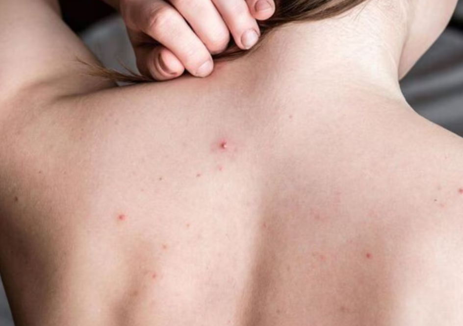 Deep Back Cleansing + Peel / Limpieza profunda de Espalda + Peel